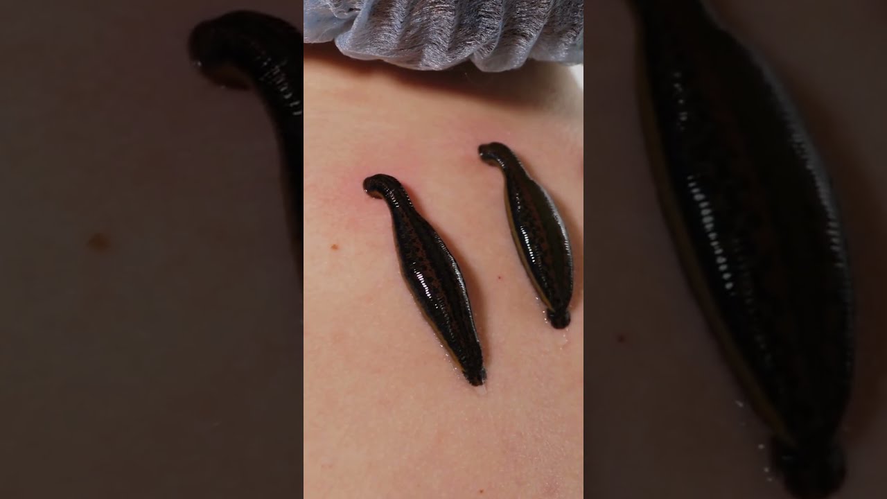 You Can Still be Prescribed Leeches | Fascinating Horror Shorts